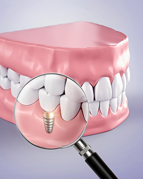 口腔种植 口腔种植