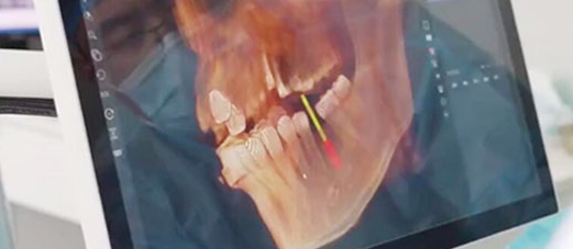 3D数字化种植术