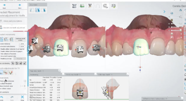智能定制，个性化矫正方案