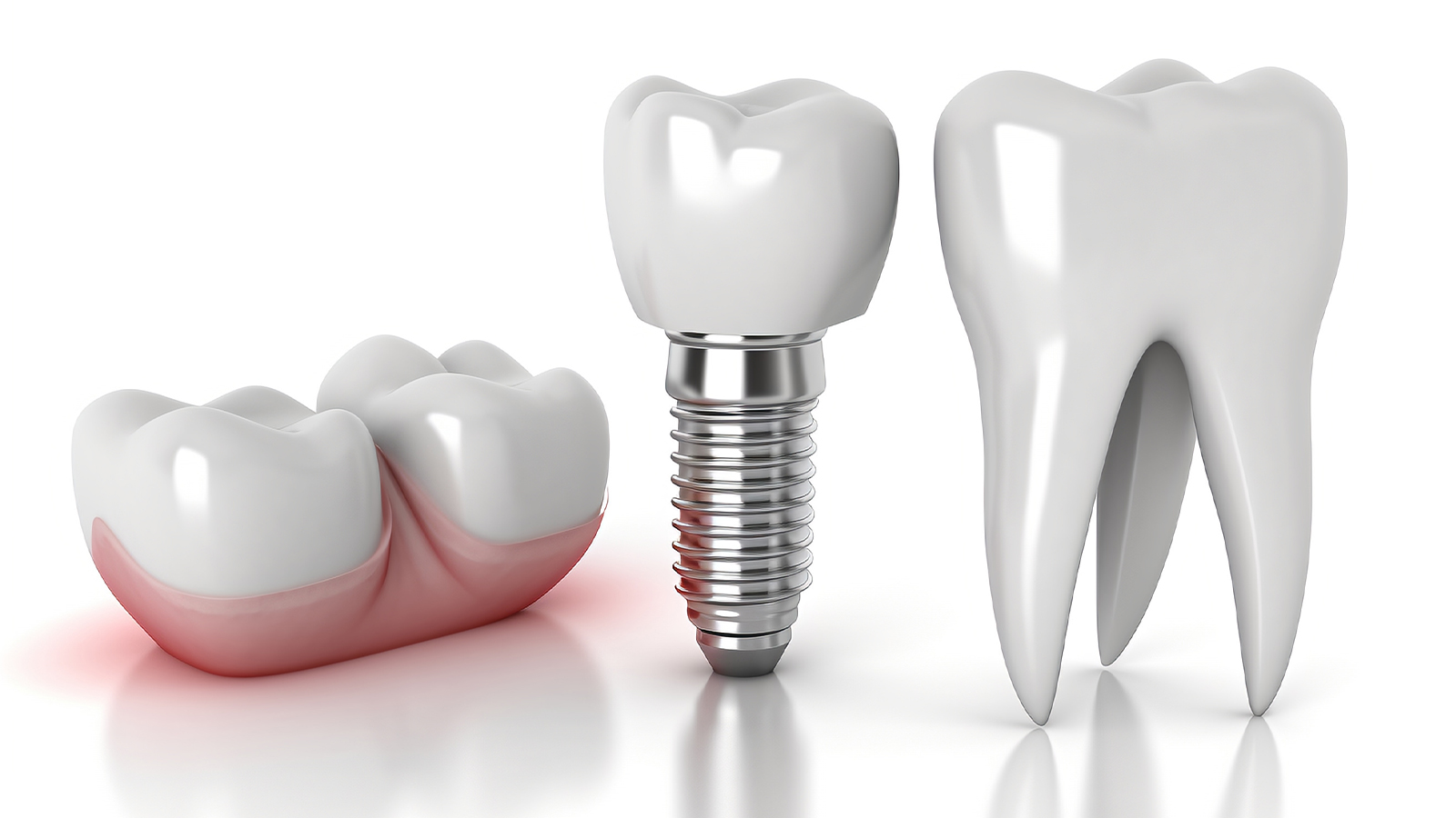 韩国sg种植体多少钱一颗?介绍SG种植体优缺自点及价格怎么样 韩国sg种植体多少钱一颗?介绍SG种植体优缺自点及价格怎么样